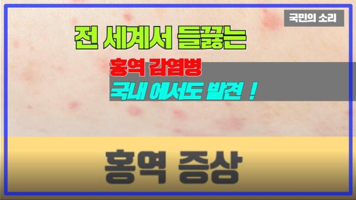 전 세계서 들끓는 홍역 감염병 국내 에서도 발견  ! 국민의소리   기사 이미지
